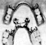 Dentures