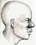 Wesley Neville reconstruction